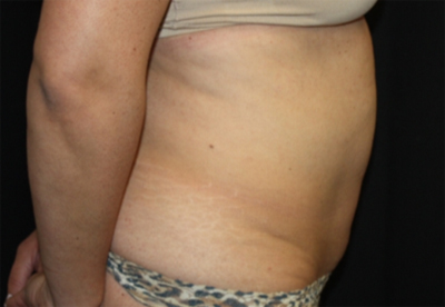 Tummy Tuck Before & After Patient #22706