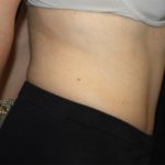 Tummy Tuck Before & After Patient #22706