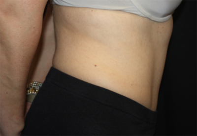 Tummy Tuck Before & After Patient #22706