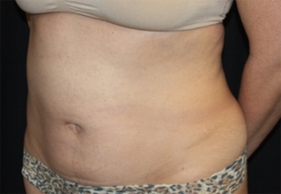 Tummy Tuck Before & After Patient #22706