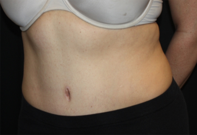 Tummy Tuck Before & After Patient #22706