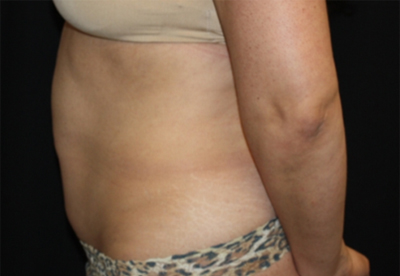 Tummy Tuck Before & After Patient #22706