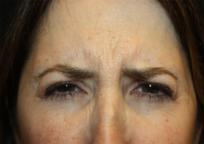 Botox and Dysport Before & After Patient #24729