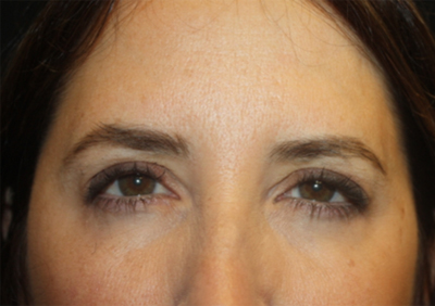 Botox and Dysport Before & After Patient #24729