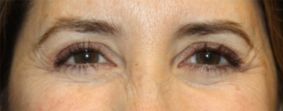 Botox and Dysport Before & After Patient #24729