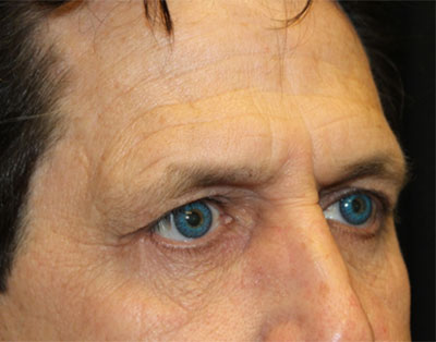 Blepharoplasty Before & After Patient #20152