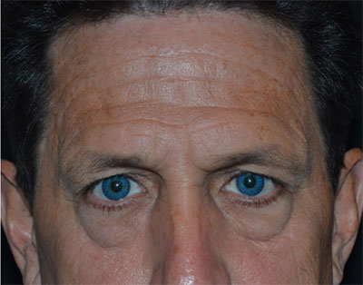 Blepharoplasty Before & After Patient #20152