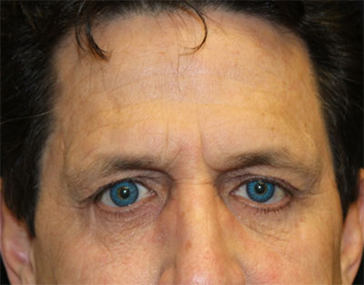 Blepharoplasty Before & After Patient #20152