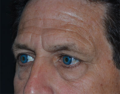 Blepharoplasty Before & After Patient #20152