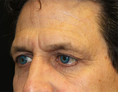 Blepharoplasty Before & After Patient #20152