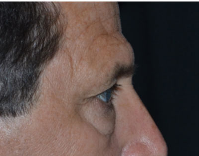 Blepharoplasty Before & After Patient #20152