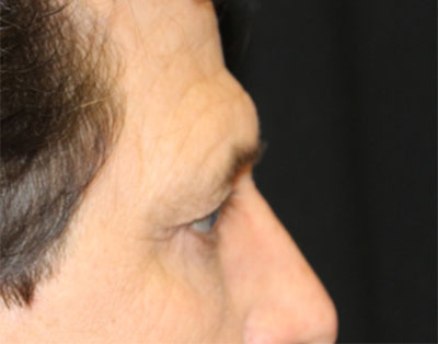 Blepharoplasty Before & After Patient #20152