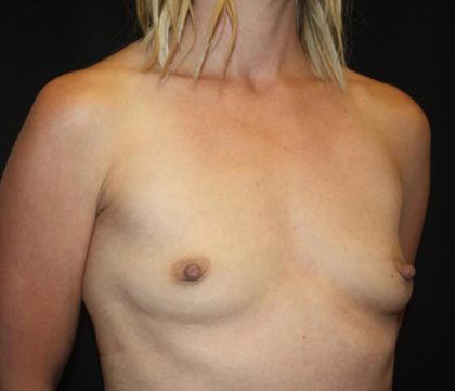 Breast Augmentation - Round Silicone Implants Before & After Patient #20366