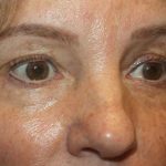 Blepharoplasty Before & After Patient #20131