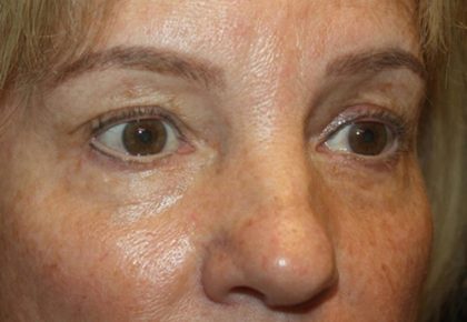 Blepharoplasty Before & After Patient #20131