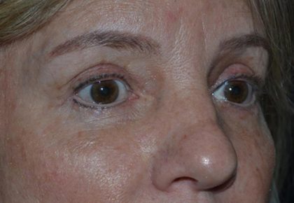 Blepharoplasty Before & After Patient #20131