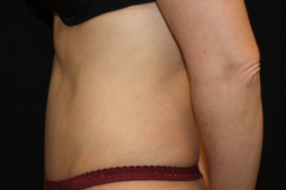 Tummy Tuck Before & After Patient #22875