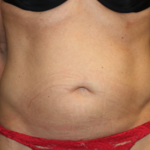 Tummy Tuck Before & After Patient #22875