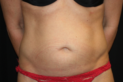Tummy Tuck Before & After Patient #22875