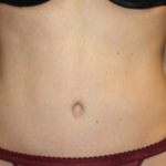 Tummy Tuck Before & After Patient #22875