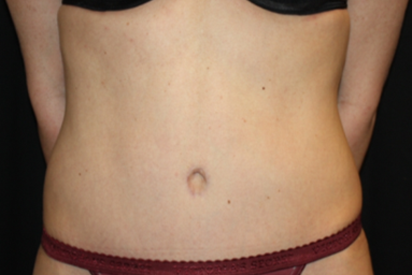 Tummy Tuck Before & After Patient #22875