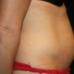 Tummy Tuck Before & After Patient #22875