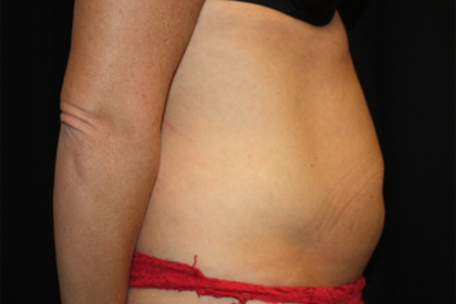 Tummy Tuck Before & After Patient #22875