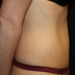 Tummy Tuck Before & After Patient #22875