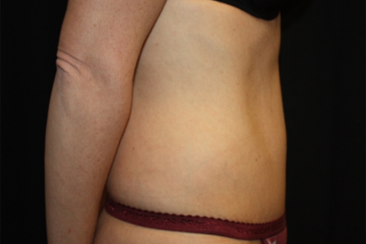 Tummy Tuck Before & After Patient #22875