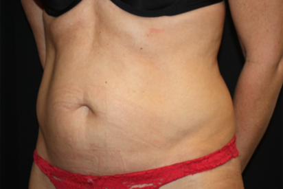 Tummy Tuck Before & After Patient #22875
