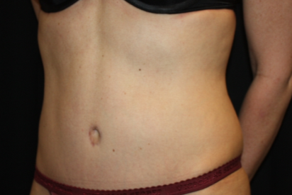 Tummy Tuck Before & After Patient #22875