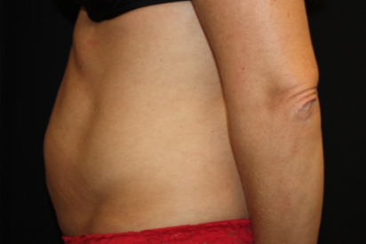 Tummy Tuck Before & After Patient #22875