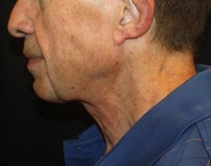 Neck Lift Before & After Patient #23511