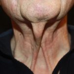 Neck Lift Before & After Patient #23511