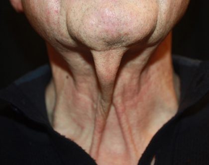 Neck Lift Before & After Patient #23511