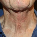 Neck Lift Before & After Patient #23511