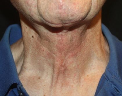 Neck Lift Before & After Patient #23511