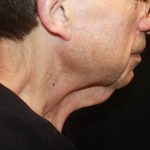 Neck Lift Before & After Patient #23511