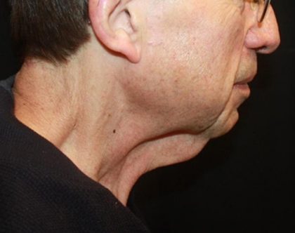 Neck Lift Before & After Patient #23511