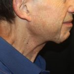 Neck Lift Before & After Patient #23511