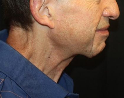 Neck Lift Before & After Patient #23511