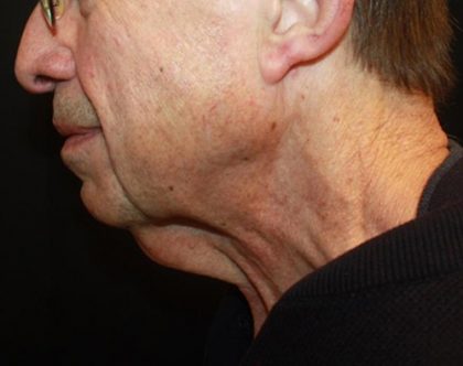 Neck Lift Before & After Patient #23511