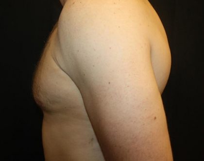 Gynecomastia Before & After Patient #21239