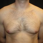 Gynecomastia Before & After Patient #21239