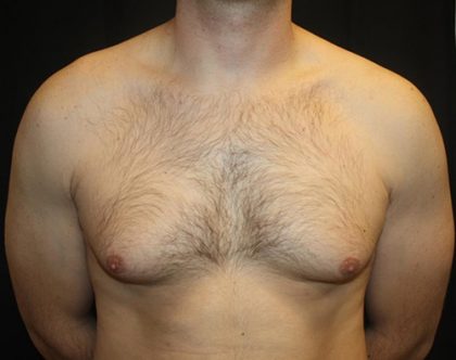 Gynecomastia Before & After Patient #21239