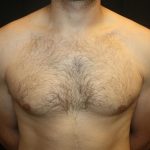 Gynecomastia Before & After Patient #21239