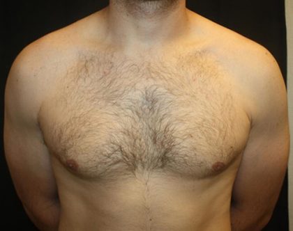 Gynecomastia Before & After Patient #21239