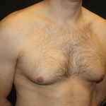 Gynecomastia Before & After Patient #21239