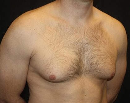 Gynecomastia Before & After Patient #21239