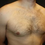 Gynecomastia Before & After Patient #21239